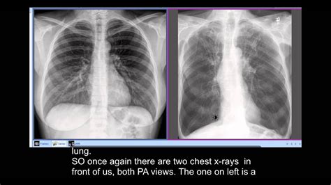 Healthy Lungs Vs Smokers Lungs X Ray