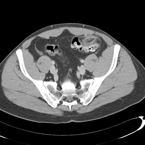 Epiploic appendagitis | Radiology Case | Radiopaedia.org | Radiology ...