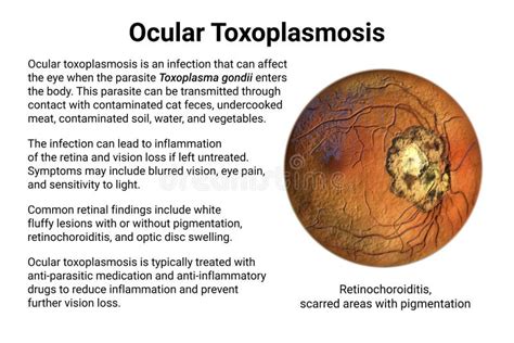 Ocular Toxoplasmosis, Retinal Scar Caused by a Toxoplasma Gondii Infection, Scientific ...