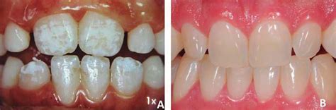 SciELO - Brasil - Microabrasion in tooth enamel discoloration defects ...