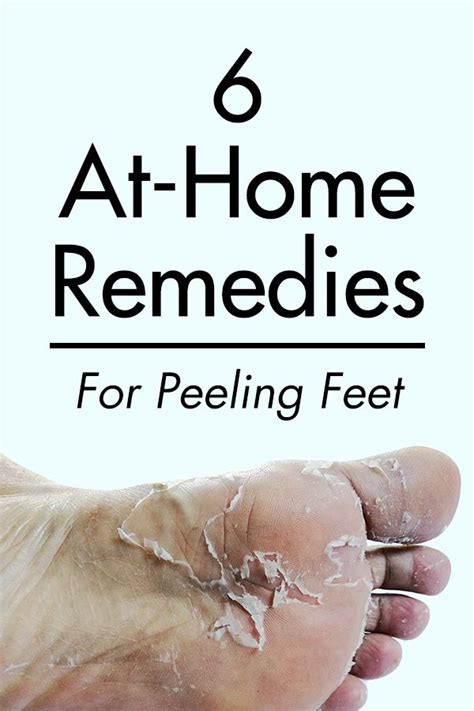 6 At-home Remedies For Peeling Feet | Dry feet remedies, Dry cracked feet, Cracked feet remedies