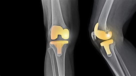 Knee Replacement Surgery: Risks and What to Expect