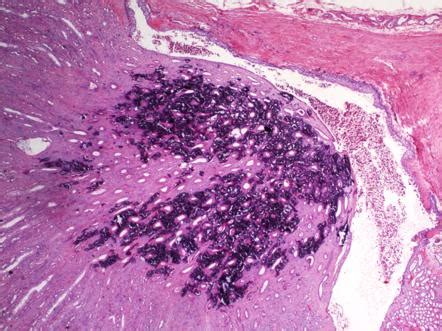 Medullary nephrocalcinosis (histology) | Radiology Case | Radiopaedia.org