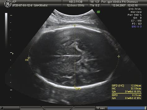 Breech Presentation Ultrasound