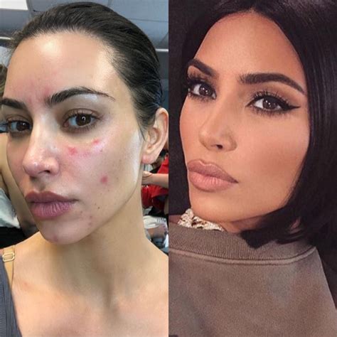 Kim Kardashian Opens Up About Struggling With Psoriasis Flare-Ups ...