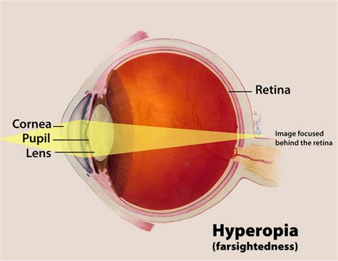 Achromatopsia: MedlinePlus Genetics