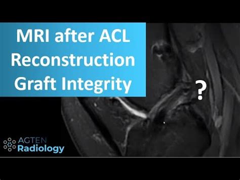 Knee MRI After ACL Reconstruction Surgery - YouTube