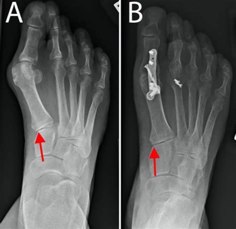 First-Tarsometatarsal Joint Alignment After First-Metatarsophalangeal ...