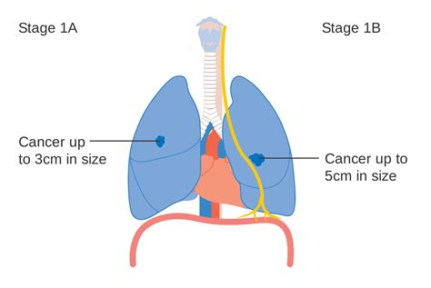 Staging of Non-Small Cell Lung Cancer - StoryMD