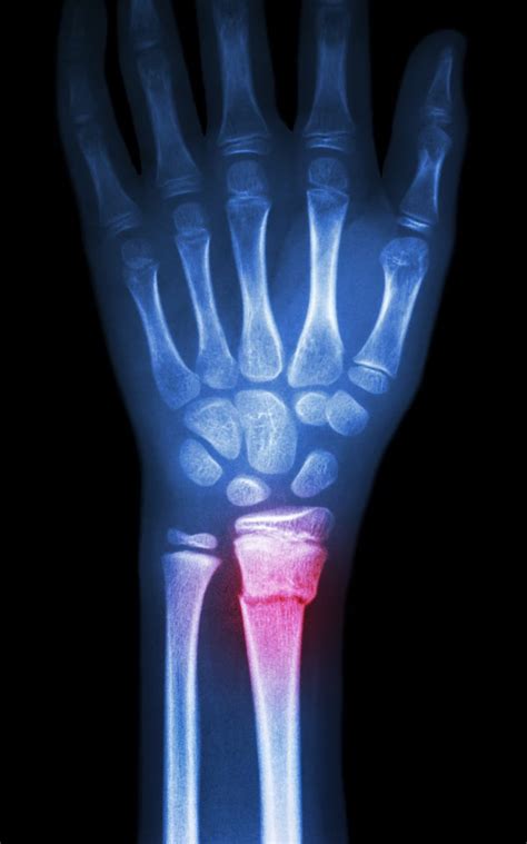 Distal Radius Fracture | SPORT Orthopedics | Dallas & Frisco, TX