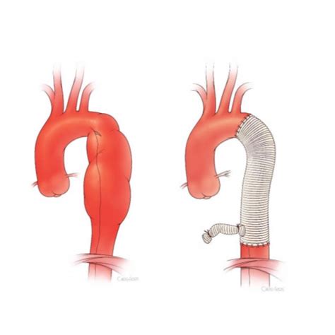 February Case of the Month: Open Repair of descending thoracic aortic aneurysm is preferred in ...