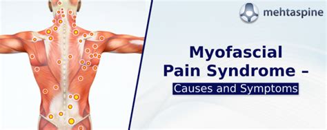 Myofascial Pain Syndrome Trigger Points Chart | Syndrome Treatment