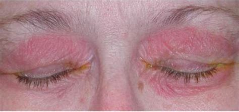 Ocular Rosacea - Pictures, Symptoms, Treatment and Causes