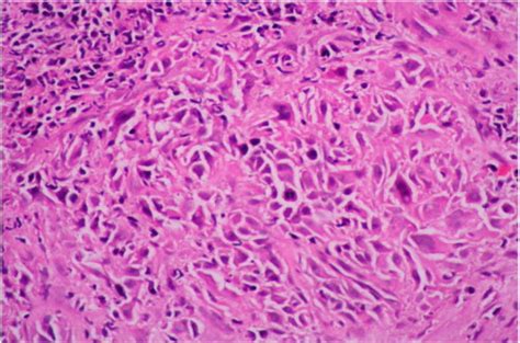 The picture of biopsy taken from left Fossa of Rosenmuller showed... | Download Scientific Diagram