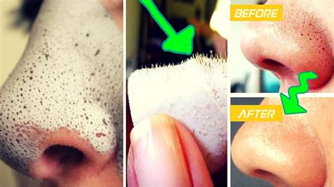 Tips to Remove Blackheads from Nose in 10 Minutes - Medy Life