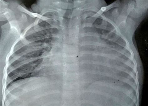 Chest x ray showing apparent cardiomegaly with anterior mediastinal... | Download Scientific Diagram