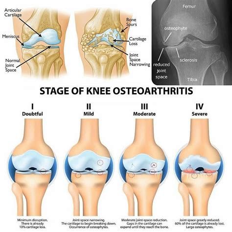 Learning about knee arthritis