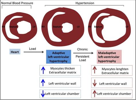 Remodeling Of Heart : Cardiac Remodeling Concepts Clinical Impact ...