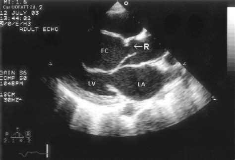 Sinus of Valsalva Rupture With Dissection Into the Interventricular ...