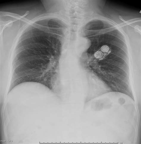 Ambulatory cardiac monitor (ZIO XT patch) on chest x-ray | Image | Radiopaedia.org