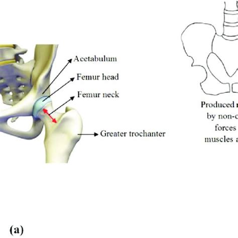 Three main types of hip fractures: femoral neck fracture (subcapital ...