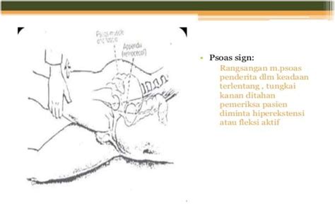 Psoas Sign