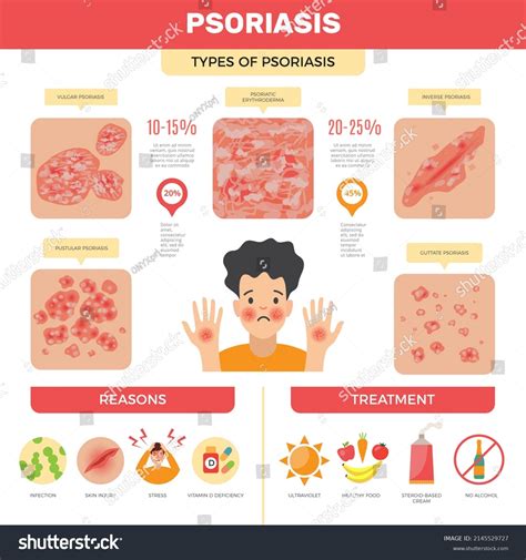 Psoriasis Infographic Human Skin Infection Psoriasis Stock Illustration 2145529727 | Shutterstock