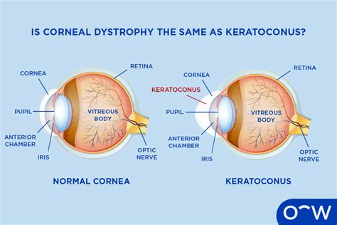 Corneal Dystrophy: Types, Symptoms, Diagnosis, and Treatment