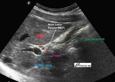 Main Lobar Fissure Ultrasound