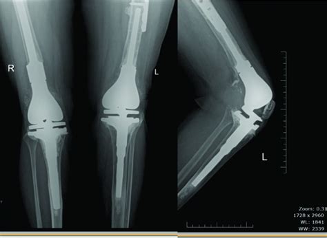 Distal Femoral Fractures: Complications and How to Avoid them? – Trauma ...