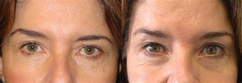 Beverly Hills Eye Asymmetry Surgery and Treatment | Dr. Mehryar Taban