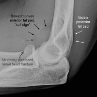 Imaging of Elbow Fractures and Dislocations in Adults: Overview, Radiography, Computed Tomography