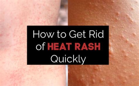 How to Get Rid of Heat Rash Quickly – 9 Remedies That Work