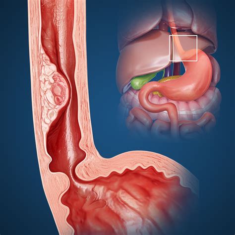 What to Expect With Esophageal Dilation