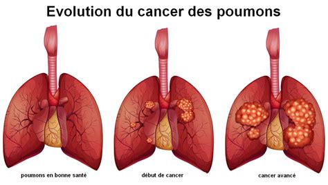 Cancer du poumon : symptômes, chance de survie, peut-on guérir