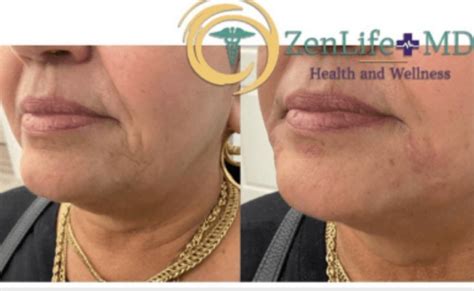 Dermal Fillers Before & After Photos | ZenLife MD