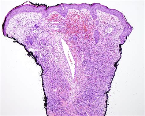 Granuloma Faciale | Dermatopathology