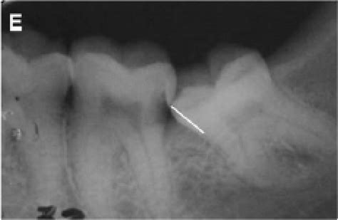 New Concepts in Impacted Third Molar Surgery | IntechOpen