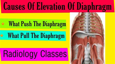 Causes Of Elevation Of Diaphragm | Chest X Rays in Hindi | X Ray Classes | Doctor Inside - YouTube