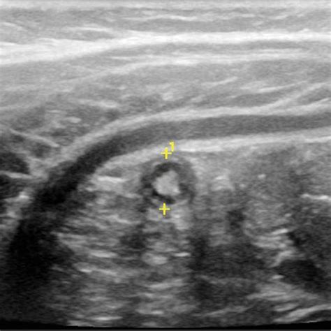 Acute appendicitis in an 18-year-old woman. Transverse ultrasound image... | Download Scientific ...