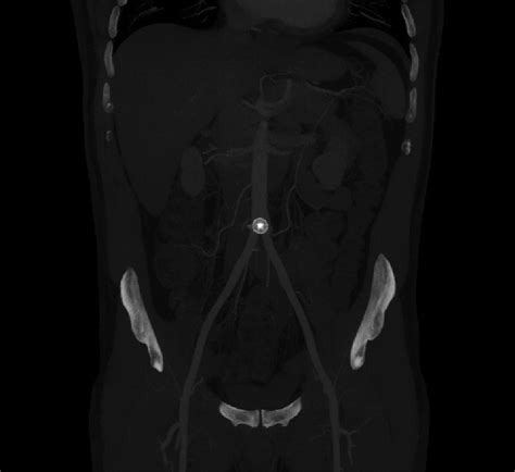 Angiotomography showing the Amplatzer device at the aortic bifurcation. | Download Scientific ...