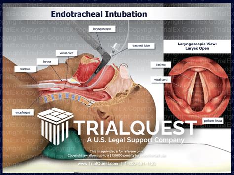 Endotracheal Intubation - TrialQuest Inc.