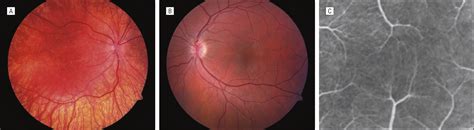 Visual Insignificance of the Foveal Pit: Reassessment of Foveal Hypoplasia as Fovea Plana ...