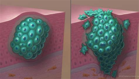 A Benign Tumor Formed by an Abnormal Collection