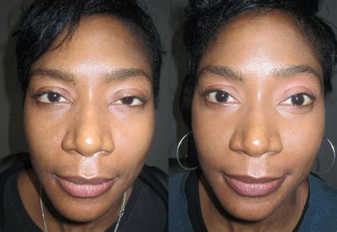 Droopy Eyelids Atlanta | Ptosis Surgery Atlanta | OPAL Aesthetics