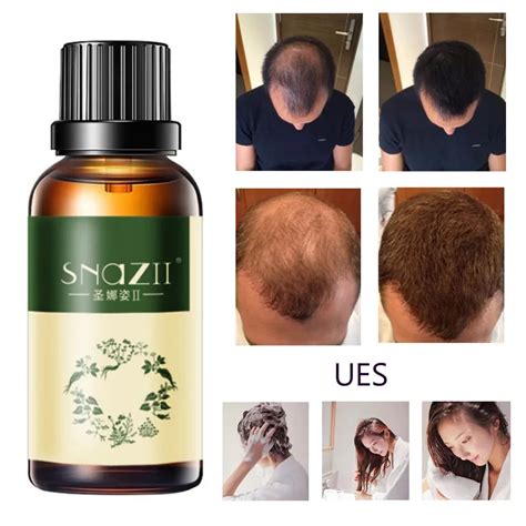 30ML Hair Growth oils Essence Advanced Thinning Hair & Hair Loss ...