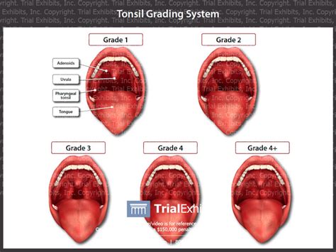 Normal Tonsils Anatomy