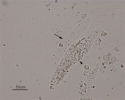 granular cast Archives | eClinpath