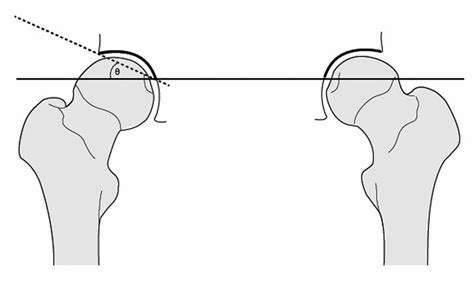 Acetabular index. A line is drawn between the points that represent the... | Download Scientific ...