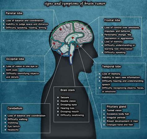 10 Warning Signs And Symptoms Of Brain Tumors You Should Know